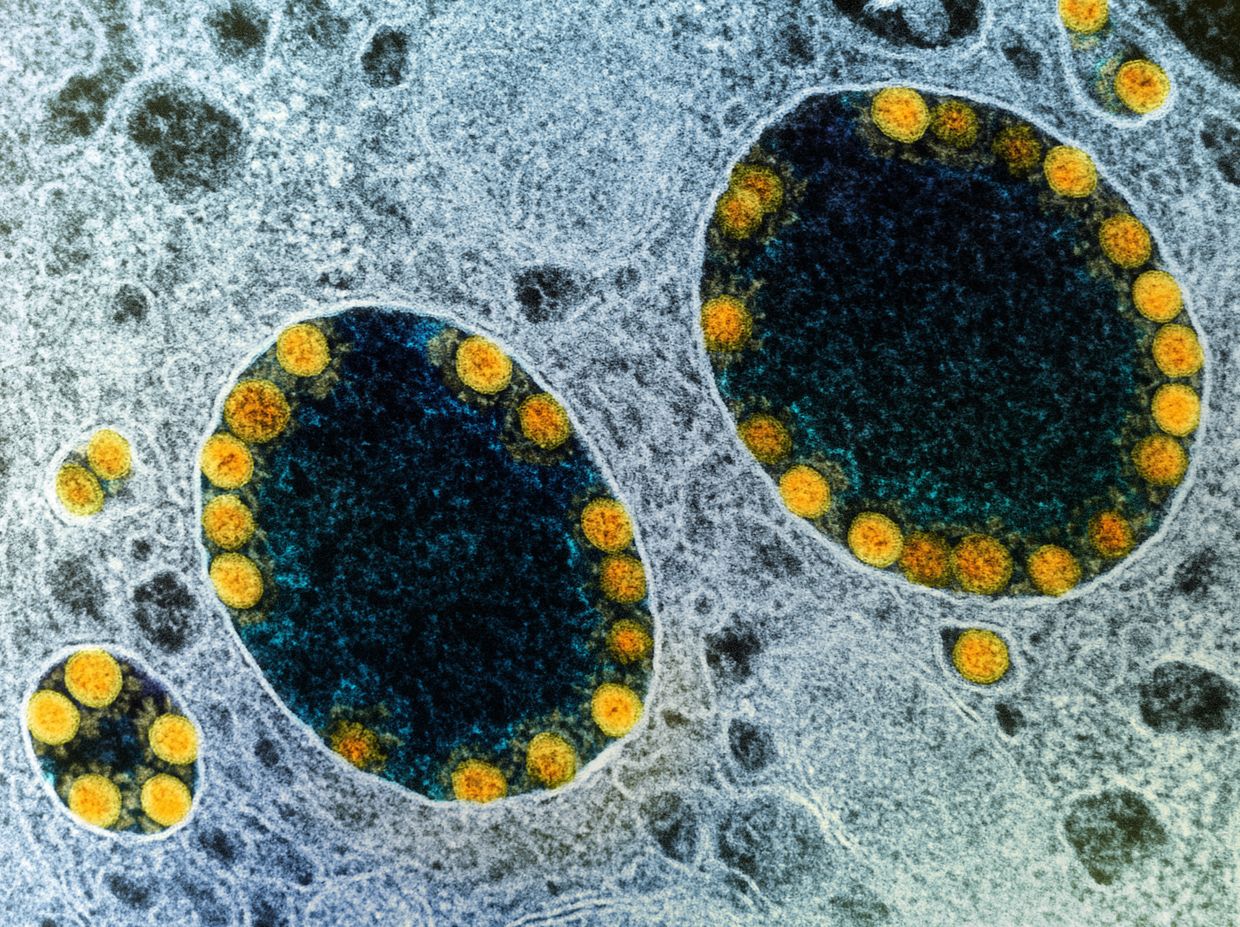 Частицы коронавируса SARS-CoV-2 в клетках эпителия дыхательных путей. (Фото: NIAID / Flickr.com)
